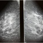 Mammografia in 3D e Tomosintesi